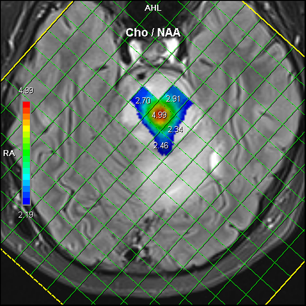 DIPG MRI image